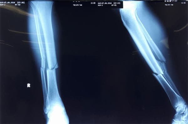 Gãy xương mác cần phải được xử trí đúng cách để tránh biến chứng