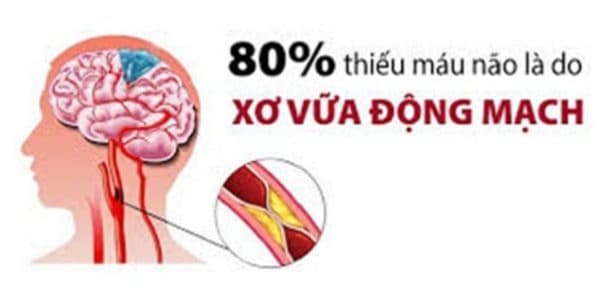 nguyên nhân thiếu máu não