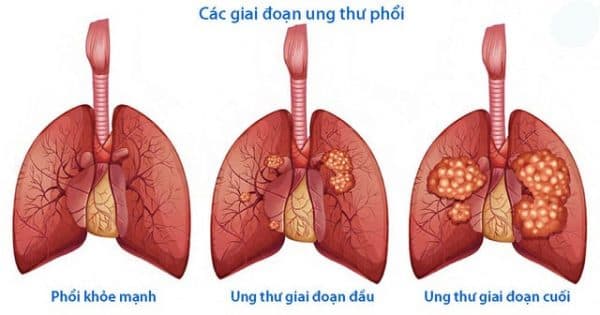 PDW cao cảnh báo ung thư phổi