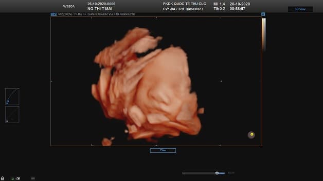 Siêu âm 5D giúp phát hiện sớm các dị tật thai nhi