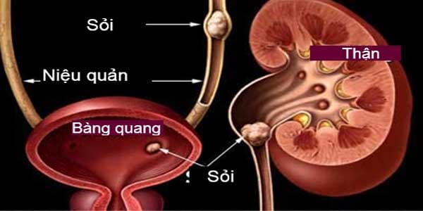 Sỏi bàng quang có thể hình thành do sỏi từ hệ tiết niệu (thận, niệu quản) rơi xuống (ảnh minh họa)