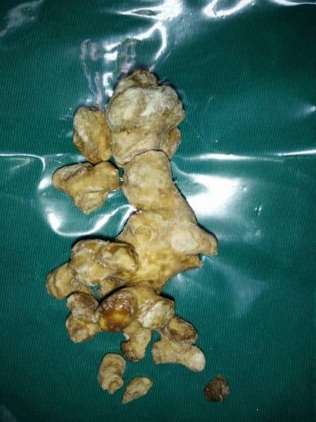 Biến chứng sỏi thận san hô