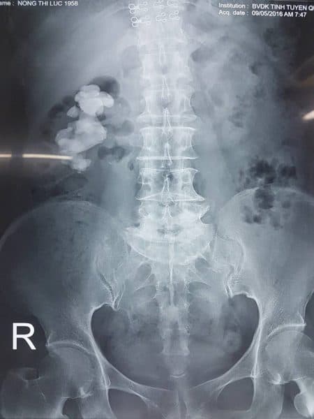 biểu hiện của sỏi thận san hô