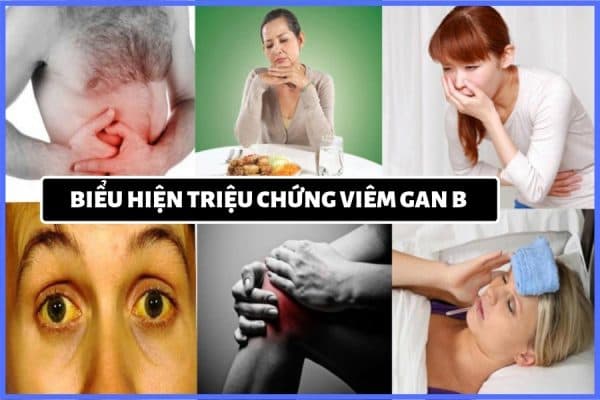 các triệu chứng của bệnh viêm gan b