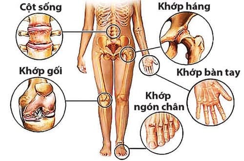 bệnh thoái hóa khớp là bệnh lý thường gặp ở người cao tuổi