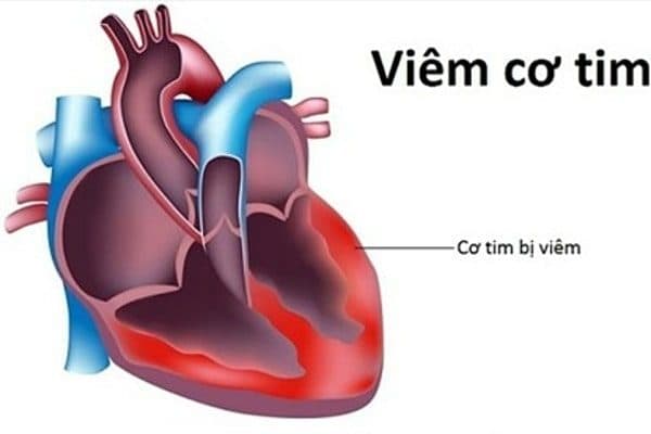 dấu hiệu bệnh viêm cơ tim 
