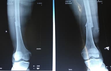 Xương chày nằm ở đâu? Gãy xương chày có nguy hiểm không?