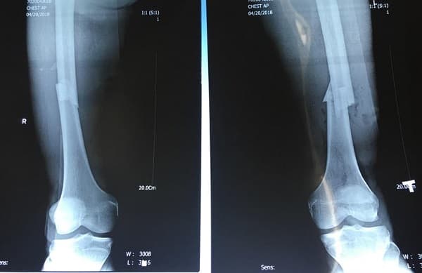 Xương chày nằm ở đâu? Gãy xương chày có nguy hiểm không?
