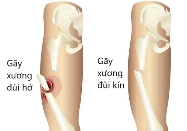Có nhiều kiểu gãy xương đùi do va đập, tai nạn...