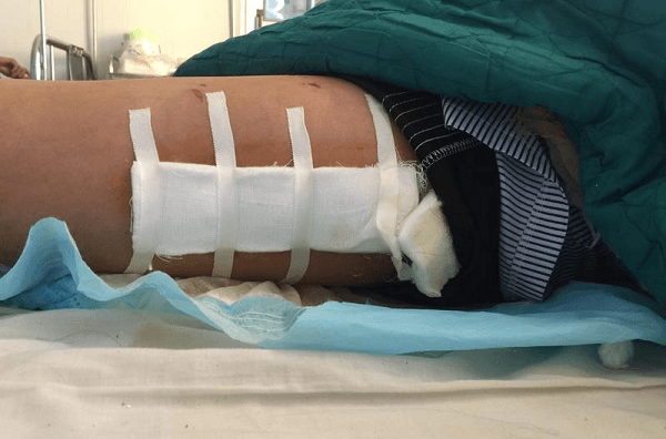 Gãy xương đùi cần được tiến hành phẫu thuật càng sớm càng tốt