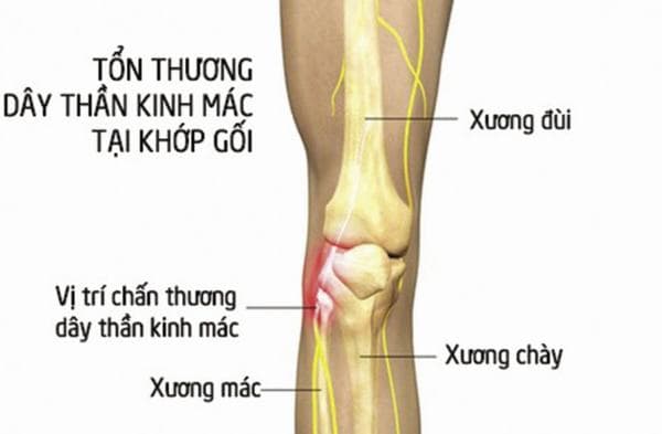 Xương mác là xương dài, nhỏ, nằm ở ngoài cẳng chân và ngoài xương chày