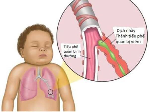 bệnh cảm lạnh có thể biến chứng viêm phế quản