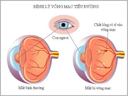 Bệnh tiểu đường cũng có thể gây biến chứng đau nhức hốc mắt. 