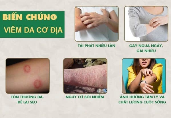 biến chứng bệnh viêm da cơ địa