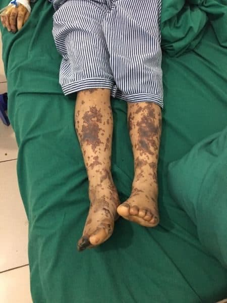 Nhiễm khuẩn liên cầu lợn cũng là một trường hợp của sốc nhiễm khuẩn cần được cấp cứu kịp thời