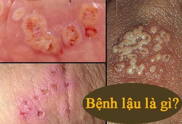 nhận biết dấu hiệu bệnh lậu ở miệng