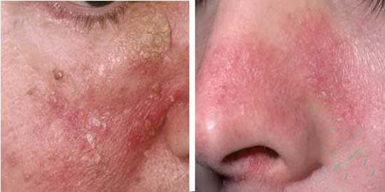 Bệnh viêm da tiết bã nhờn da có màu đỏ cam, trên thường phủ vảy xám trắng khô hoặc mỡ nhờn, đôi khi thấy các vết sẩn vảy ra, thường xuất hiện ở các khu vực như mặt, đầu,... (ảnh minh họa)