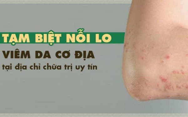 Điều trị viêm da cơ địa