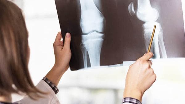 Thời gian phục hồi xương bánh chè sau gãy nhanh hay chậm phụ thuộc vào mức độ gãy, phương pháp điều trị...