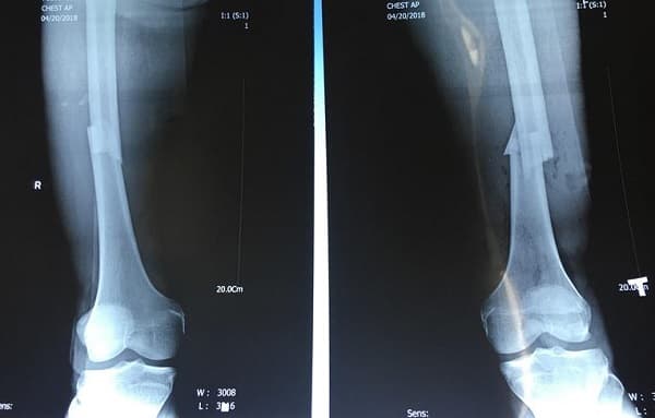 Gãy xương đùi có thể phát hiện qua chụp X-quang hoặc chụp CT