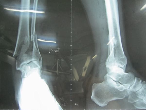 Gãy xương mác cẳng chân bao lâu thì lành