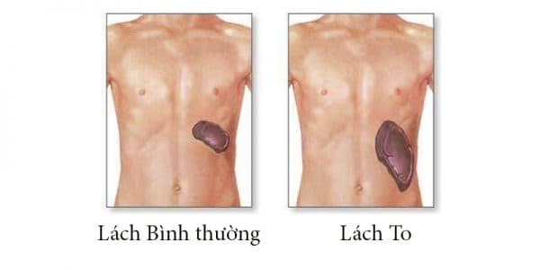 Lá lách to nếu không được thăm khám và điều trị kịp thời khi gặp phải một số chấn thương hay tác động từ bên ngoài có thể gây vỡ lách sẽ rất nguy hiểm đến tính mạng. (ảnh minh họa)