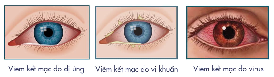 nguyên nhân gây viêm kết mạc mắt