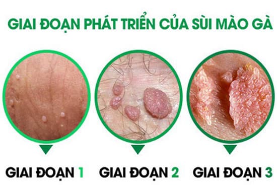 nhận biết sớm dấu hiệu bệnh sùi mào gà