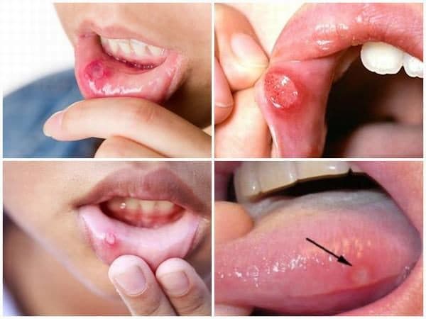 Nhiệt miệng là những vết loét ở miệng (ảnh minh họa)