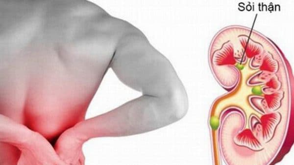 Sỏi tiết niệu có thể gây ra đau bụng, đau mỏi vùng thắt lưng, nhất là vùng bụng phía bộ phận tiết niệu có sỏi (ảnh minh họa)