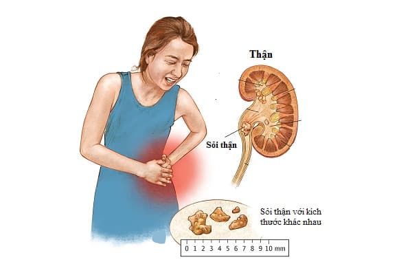 Dấu hiệu của sỏi thận gây ứ nước