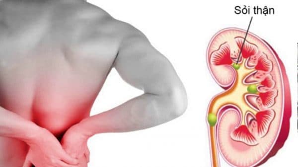 Sỏi thận gây đau bụng như thế nào?