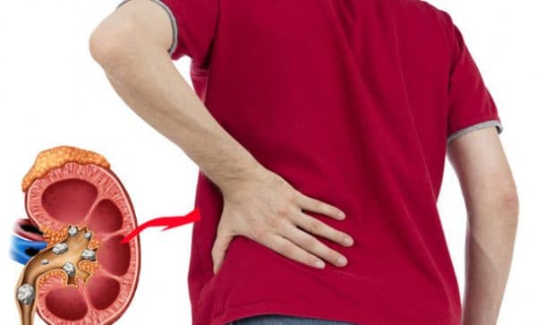 Sỏi thận -tiết niệu có thể gây ra cho người bệnh cảm giác đau âm ỉ ở hố thắt lưng (ảnh minh họa