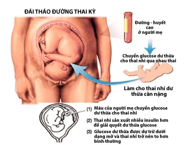 tiểu đường thai kỳ nguy hiểm như thế nào?