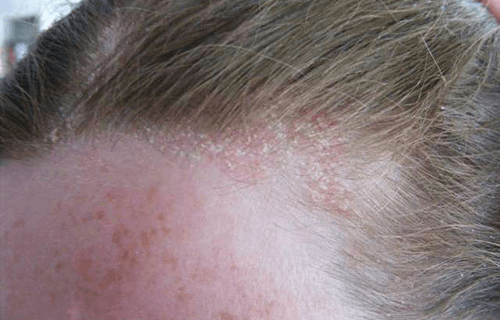 Tóc nhiều gàu, vảy có thể do bệnh viêm da tiết bã nhờn 
