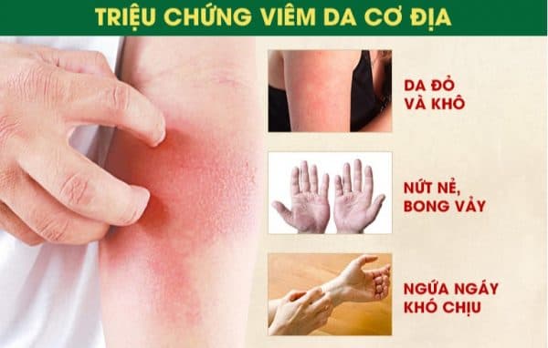 triệu chứng viêm da cơ địa