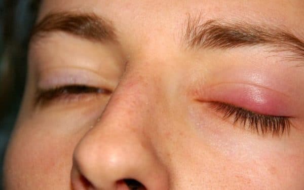 Viêm bờ mi mắt gây khó khăn trong việc nhìn, cử động mí mắt, mất thẩm mỹ trên gương mặt. (ảnh minh họa)