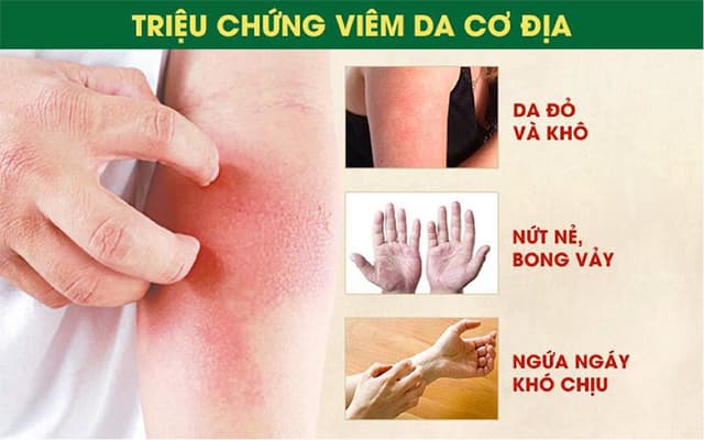 Đề phòng viêm da cơ địa khi thời tiết hanh khô