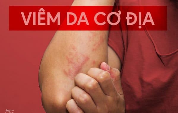 Viêm da cơ địa hay còn gọi là bệnh chàm hoặc eczema.