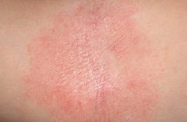 viêm da dị ứng