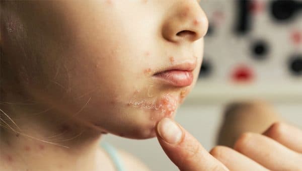 viêm da mủ do liên cầu khuẩn gây ra