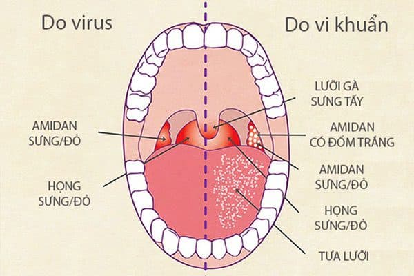 Nguyên nhân trẻ bị viêm họng