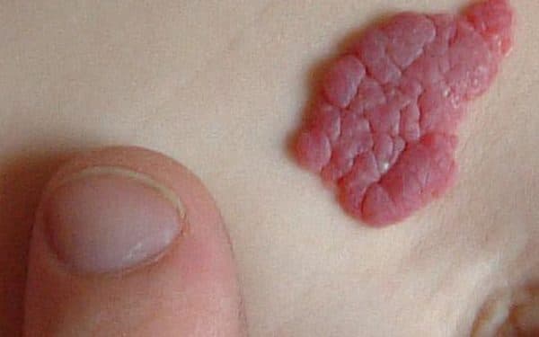 bướu máu ở trẻ em là gì