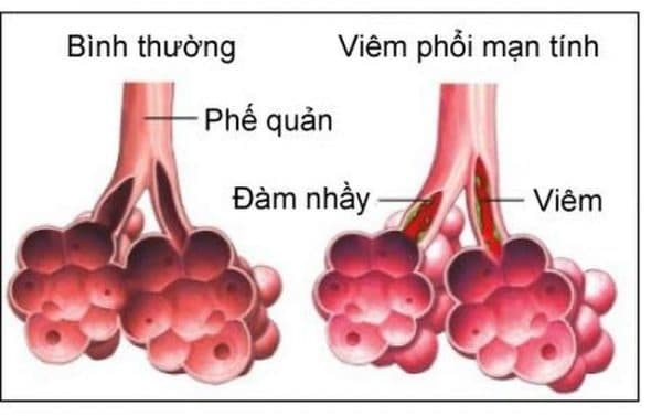 cảm lạnh có thể gây biến chứng viêm phế quản và chuyển sang viêm phổi rất nhanh. 