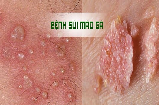 bệnh sùi mào gà có gây ngứa không 