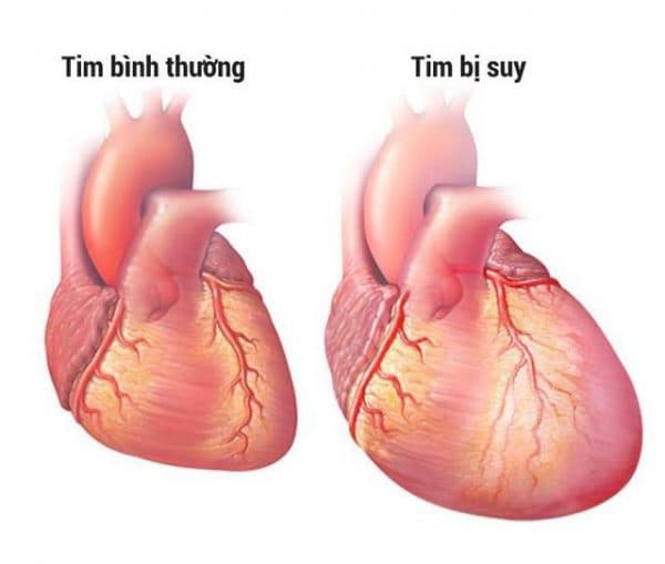 hở van tim có chữa được không?