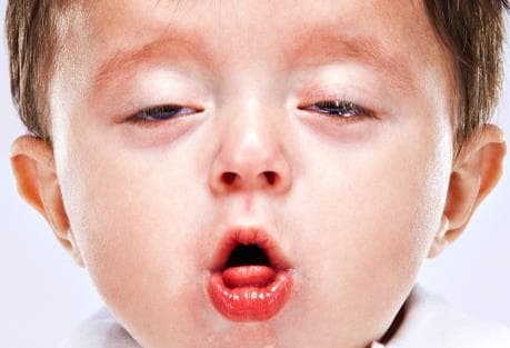 biểu hiện ho gà ở trẻ 