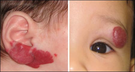 bướu máu ở trẻ em có nguy hiểm không