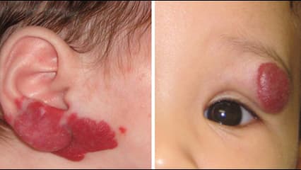 biểu hiện bệnh bướu máu ở trẻ em 