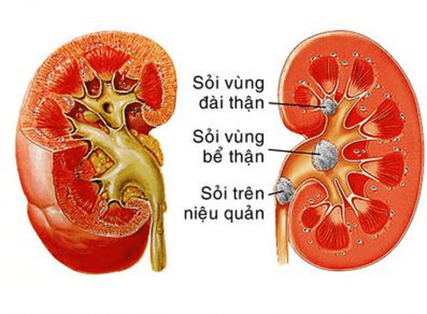 Cặn thận gây sỏi thận